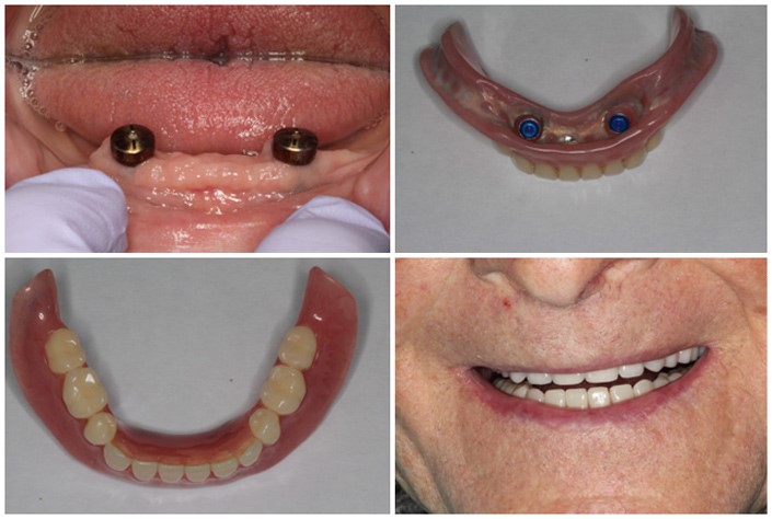 Braces With Dentures South Bend IN 46619